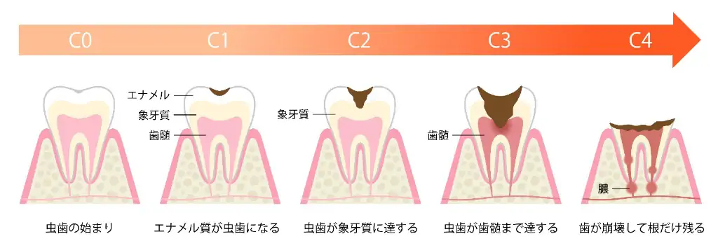 虫歯の進行段階（C0〜C4）のイラスト
