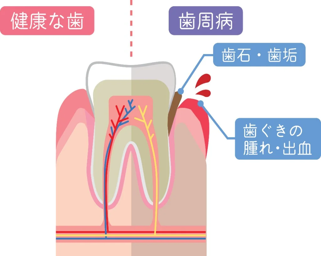 健康な歯と歯周病の歯の比較イラスト